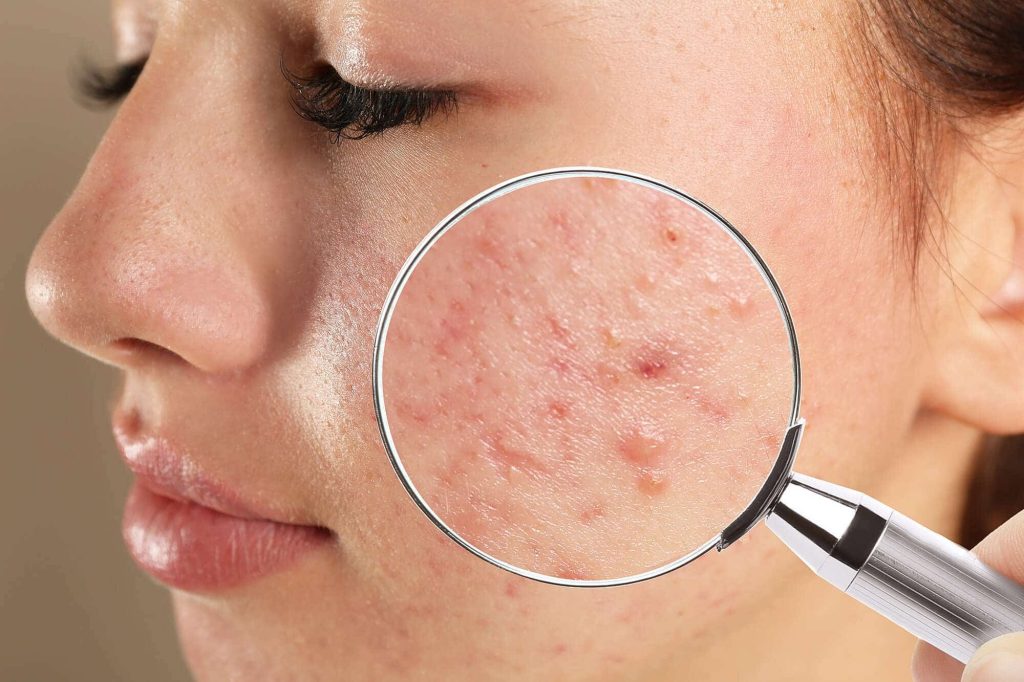 Acne Care