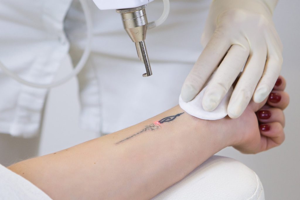 tattoo removal